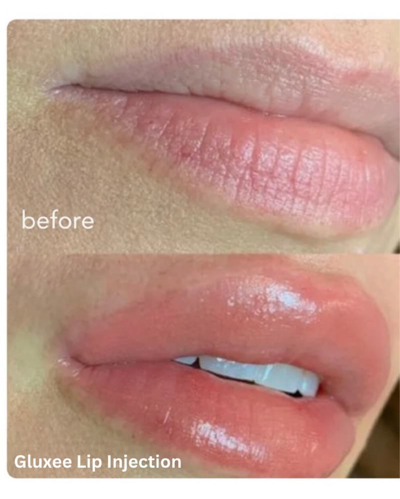 Lip Injection Plumpler  - Image 1